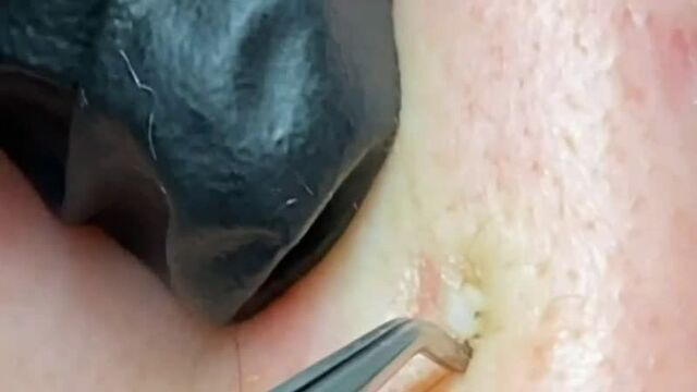 Выдавливание акне и прыщей на лице! как избавиться от прыщей! выдавливание черных точек и прыщей!