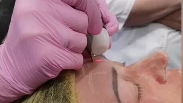 Лазерный пилинг. шлифовка морщин. эстетик клуб.