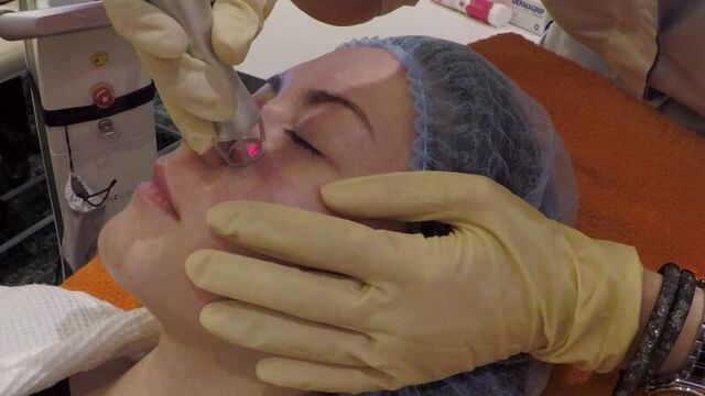 Кирсанова л.в. врач-косметолог института красоты спика. лазерная шлифовка