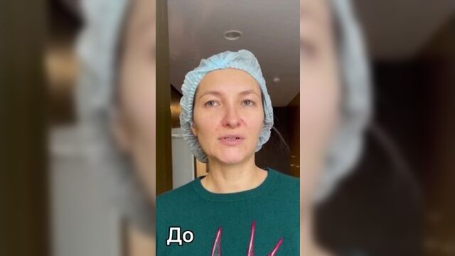 Пациент с розацеа. результат лечения. дерматолог в москве перевалова елена геннадьевна