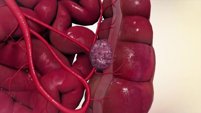 Как происходит метастазирование