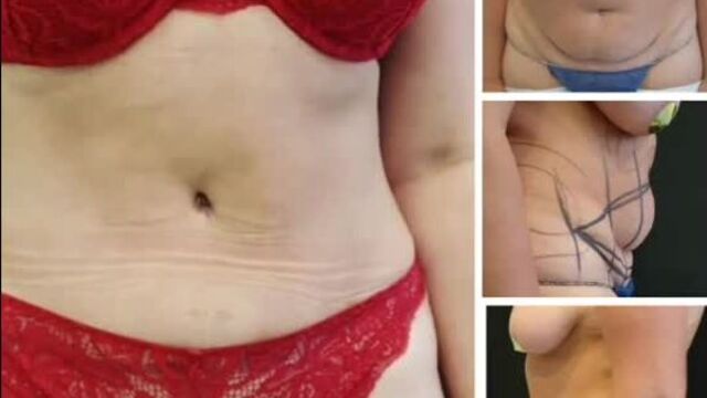 Абдоминопластика и липосакция. вуйлов м.в. umg клиника новосибирск